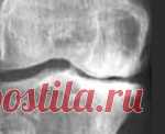 Остеосклероз Остеосклероз. Симптомы. Диагностика. Что делать при диагнозе Остеосклероз. Консервативное лечение и операции. Платные и бесплатные клиники, в которых лечится Остеосклероз.