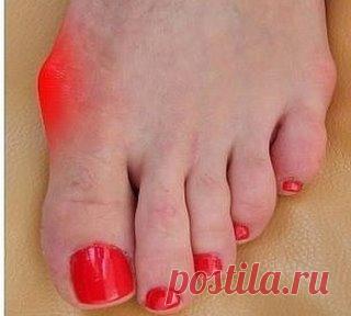 Косточка больше не болит! Потратила мелкие деньги на 2 средства, эффект невероятен. 
Помню, как однажды на уроке биологии почувствовала себя по-настоящему ужасно. Мы изучали что-то связанное с генетикой, и учительница рассказывала нам о том, какие генетические заболевания передаются по наследству. 
В качестве яркого примера она привела косточку на ноге. Увеличенная косточка, некрасивая и болезненная, как подробно расписывала преподавательница, передается по наследству по женской линии. Если у