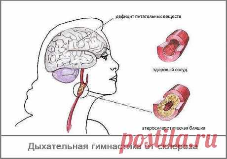 #Мое_здоровье#
Дыхание от склероза - дыхательная гимнастика Л.А.Анисимова.

Эта гимнастика помогает при самых разных заболеваниях, в частности, склерозе сосудов головного мозга и инсульте.Буквально через месяц серьёзных занятий вы почувствуете,что находитесь на верном пути. .Сначала следует выбрать позу: или полулежа в кресле, или на спине - кому как удобно. Расслабьтесь, отбросьте все житейские заботы и приступайте.Закрываем пальцем левой руки левую ноздрю и спокойно, оче...