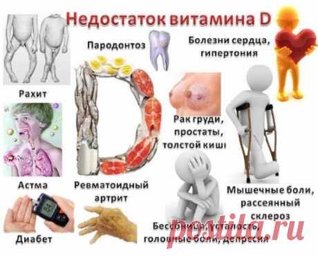 Недостаток витамина Д. Симптомы у взрослых женщин, мужчин. Признаки дефицита (нехватки) витамина D