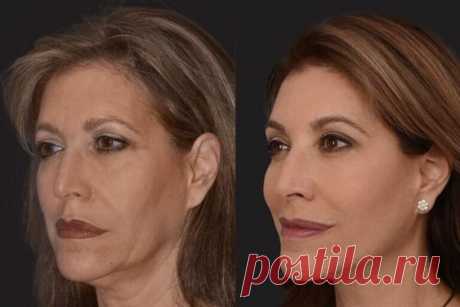 Убрать брыли лазером в Киеве без боли. Цена, отзывы- Coolaser Clinic
