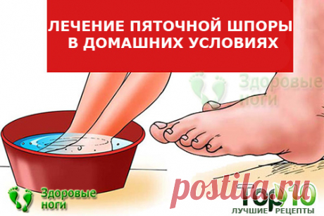 Топ-10 методов лечения пяточной шпоры в домашних условиях. Проверенные рецепты, как вылечить пяточную шпору на дому
