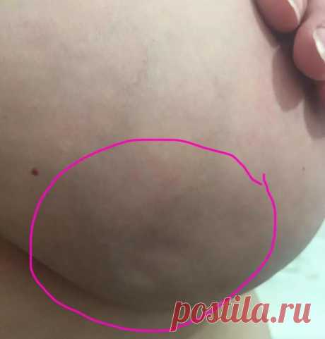 Женщина поделилась фотографией признаков редкого типа рака груди, который не выявили на маммограмме