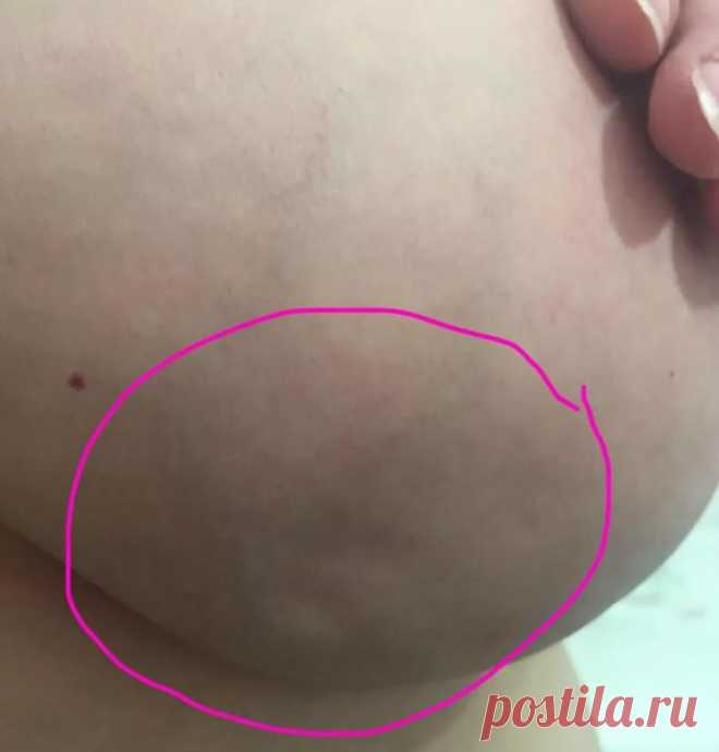 Женщина поделилась фотографией признаков редкого типа рака груди, который не выявили на маммограмме