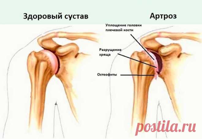 Артроз плечевого сустава: народные методы лечения