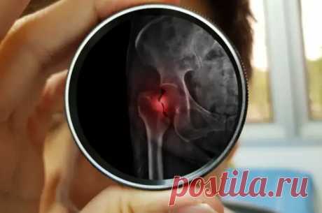 Диагноз-приговор. Лечится ли перелом шейки бедра и как? - ПолонСил.ру - социальная сеть здоровья - 24 января - 43624393447 - Медиаплатформа МирТесен