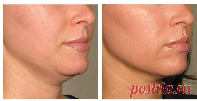3 СПОСОБА ИЗБАВЛЕНИЯ ОТ ДВОЙНОГО ПОДБОРОДКА БЕЗ ТАБЛЕТОК, ИНЪЕКЦИЙ ИЛИ ХИРУРГИИ