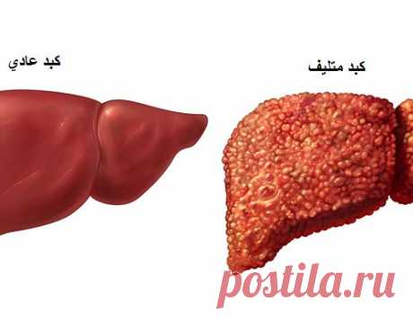 Цирроз печени - народное  - МирТесен