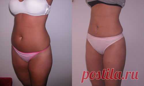 Многие полные девушки считают - добиться плоского животика невыполнимая задача! Я же уверенна в обратном!

Советую вам попробовать данный способ - вы сможете сбросить до 5 килограмм лишнего веса и похвастаться животиком без жира.