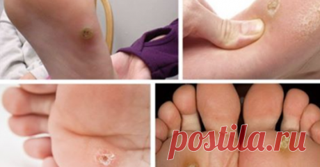 10 хвилин – і ніяких натоптишів та мозолів. Простий і досить ефективний рецепт…