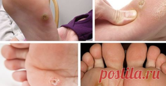 10 хвилин – і ніяких натоптишів та мозолів. Простий і досить ефективний рецепт…