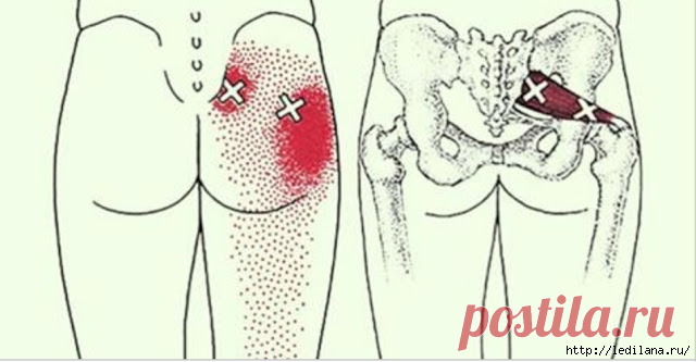 Эти простые упражнения быстро снимут боль в пояснично-крестцовом отделе!