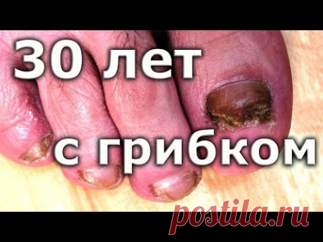 (592) ВЫЛЕЧИЛ грибок ногтей спустя 30 лет / Лечение грибка ногтей на ногах - YouTube