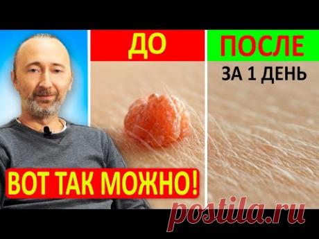 Как избавиться от папиллом, кератом и бородавок за 1 день самостоятельно и натуральными средствами?