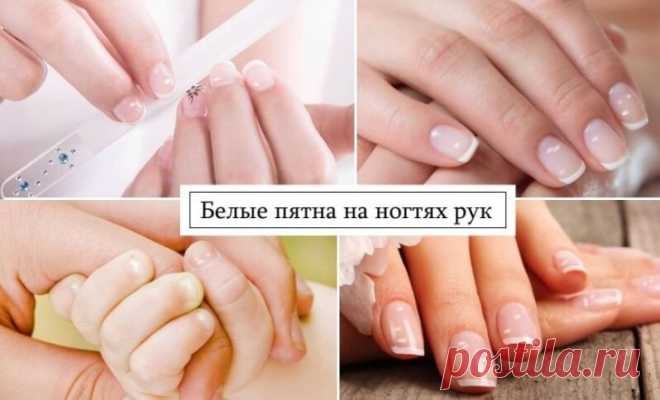 Белые пятна на ногтях рук: причины белых точек, полосок и полукругов на ногтях и под ними