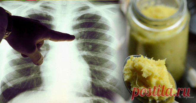 Натуральний та дієвий засіб лікування пневмонії. Знімає запальний процес, та полегшує кашель Цей рецепт не є головним засобом лікування пневмонії, а лише допомагає позбутися нав’язливого кашлю. Ним можна скористатися в лікуванні бронхіту та будь-якої застуди. Продукти прості й доступні кожній людині.    Інгредієнти:     	Ріпчаста цибуля 1 шт.;   	Корінь хрону