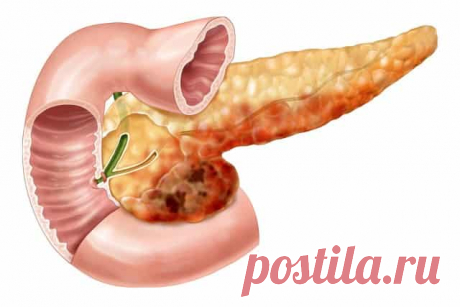 Панкреатит у Взрослых – Симптомы, Лечение и Диета Панкреатитом на языке медиков называют воспалительное заболевание поджелудочной железы, которое развивается вследствие нарушения оттока вырабатываемого железой секрета или ранней активации ферментов, из-за чего они начинают переваривать не поступающую в организм пищу, а сам орган. Если своевременно не остановить этот процесс, это может грозить больному летальным исходом.