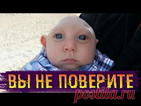 Помните мальчика, который родился без головного мозга? Вот как он живет теперь ...