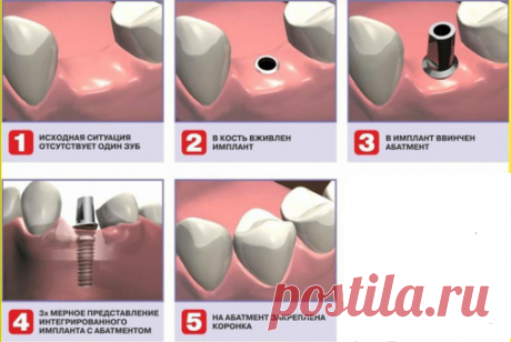 Имплантация зубов, цены на зубные импланты и восстановление зубов. | Zdorovie-L