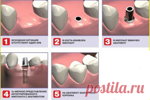 Имплантация зубов, цены на зубные импланты и восстановление зубов. | Zdorovie-L
