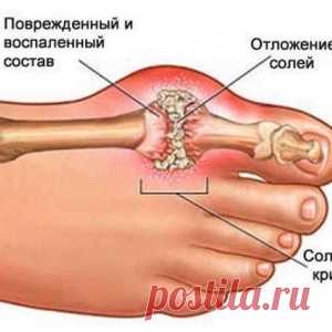Удаляемь мочекислую кристаллизацию для предотвращения подагры и боли в суставах