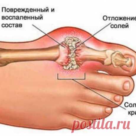 Удаляемь мочекислую кристаллизацию для предотвращения подагры и боли в суставах