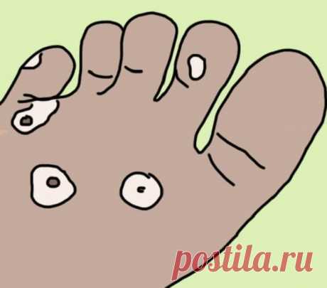 Простые решения неприятных болезней ног.