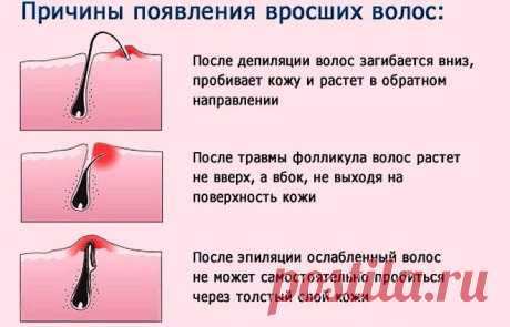 Вросшие волосы – правильная диагностика определяет эффективность лечения