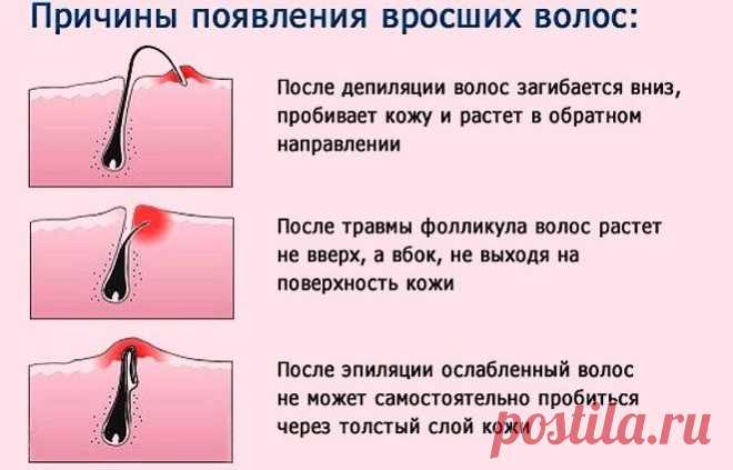 Вросшие волосы – правильная диагностика определяет эффективность лечения