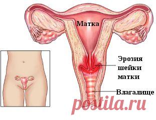 ЛЕЧЕНИЕ ЭРОЗИИ ШЕЙКИ МАТКИ