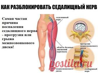 Как разблокировать седалищный нерв: 2 простых способа снять боль. 
Седалищный нерв свое начало берет в поясничном отделе позвоночника и, проходя через ягодицы, тянется к ступне. Поэтому боль при его защемлении чувствуется особенно сильно. 

Как правило, термин «защемление/ущемление седалищного нерва» подразумевает потерю эластичности и гибкости мышц задней поверхности ноги. Это часто связано с процессом возрастного укорочения (ригидности) мышц, который может начаться уже п...