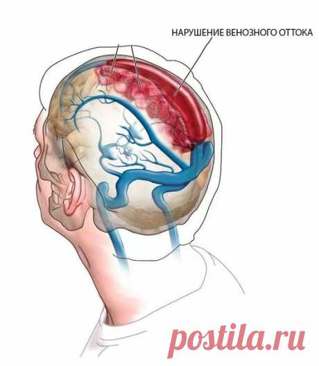 Венозный застой в голове: ЧТО делать?

Головокружение, неустойчивая походка, даже тошнота - вот основные проявления венозного застоя. Венозный застой (особенно с возрастом) возникает из-за нарушения кровообращения головного мозга, в частности гипоксии (недостаточного снабжения тканей кислородом) мозжечка и вестибулярного аппарата.

Венозный застой (особенно с возрастом) возникает из-за нарушения кровообращения головного мозга, в частности гипоксии (недостаточного снабжения...