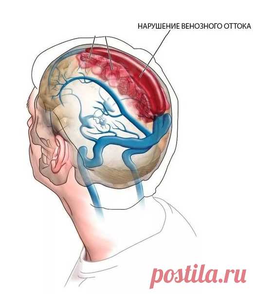 Венозный застой в голове: ЧТО делать?

Головокружение, неустойчивая походка, даже тошнота - вот основные проявления венозного застоя. Венозный застой (особенно с возрастом) возникает из-за нарушения кровообращения головного мозга, в частности гипоксии (недостаточного снабжения тканей кислородом) мозжечка и вестибулярного аппарата.

Венозный застой (особенно с возрастом) возникает из-за нарушения кровообращения головного мозга, в частности гипоксии (недостаточного снабжения...