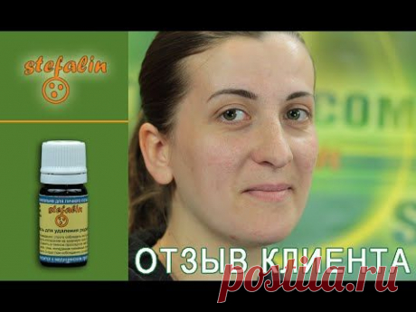 Видео-отзыв об удалении родинки на подбородке. Екатерина Желдакова.