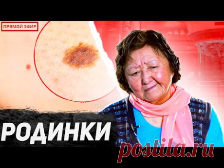 В чём опасность родинок