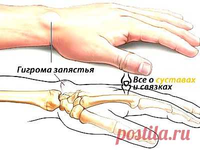 Гигрома запястья: причины, лечение, удаление.