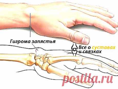 Гигрома запястья: причины, лечение, удаление.