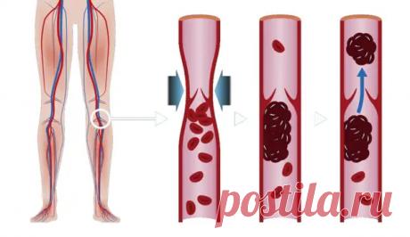 Признаки и симптомы тромбоза глубоких вен - ПолонСил.ру - социальная сеть здоровья - Медиаплатформа МирТесен