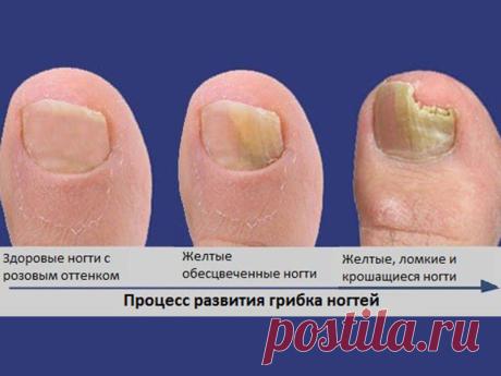 Как грибок ногтей влияет на организм - О грибке ногтей
2.1 Как грибок влияет на организм. 2.2 Где можно встретить грибок и пути заражения. 2.3 Когда заражение переходит в заболевание. ... Чем может быть опасен грибок ногтей на ногах. Как он влияет на наше здоровье, и качество жизни в целом. Что будет, если его игнорировать, об этом всем здесь и сейчас