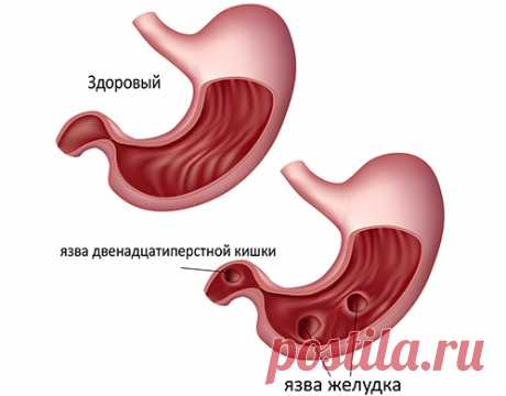 Народные средства в лечении язвы желудка — Здоровое Долголетие