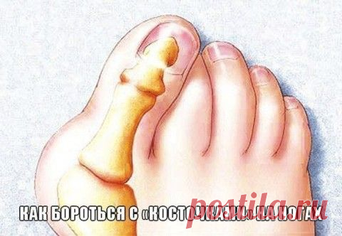 Как бороться с «косточками» на ногах. | Мамам, женщинам, бабушкам и очень любознательным.