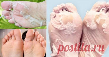Полностью избавиться от трещин, мозолей, а также сухой и огрубевшей кожи поможет этот рецепт! - Страница 2 из 2 Хотите красивую и гладкую кожу на пятках? Это удивительное средство с аспирином поможет избавиться от сухой и потрескавшейся кожи! 100% результат!