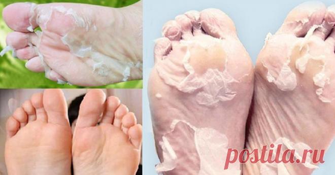 Полностью избавиться от трещин, мозолей, а также сухой и огрубевшей кожи поможет этот рецепт! - Страница 2 из 2 Хотите красивую и гладкую кожу на пятках? Это удивительное средство с аспирином поможет избавиться от сухой и потрескавшейся кожи! 100% результат!