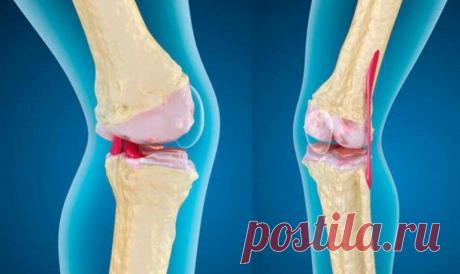 Дедова настойка спасла мне колени - боль ушла, и не возвращается!