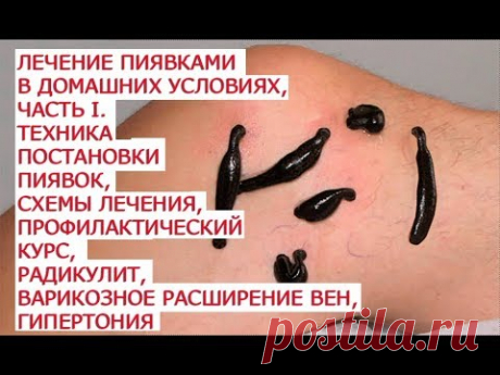 Лечение пиявками в домашних условиях, часть I  Техника постановки пиявок, схемы лечения, профилактич