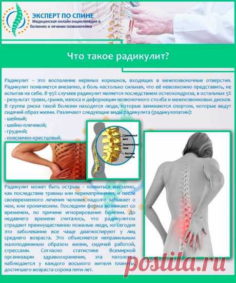 Что такое радикулит?