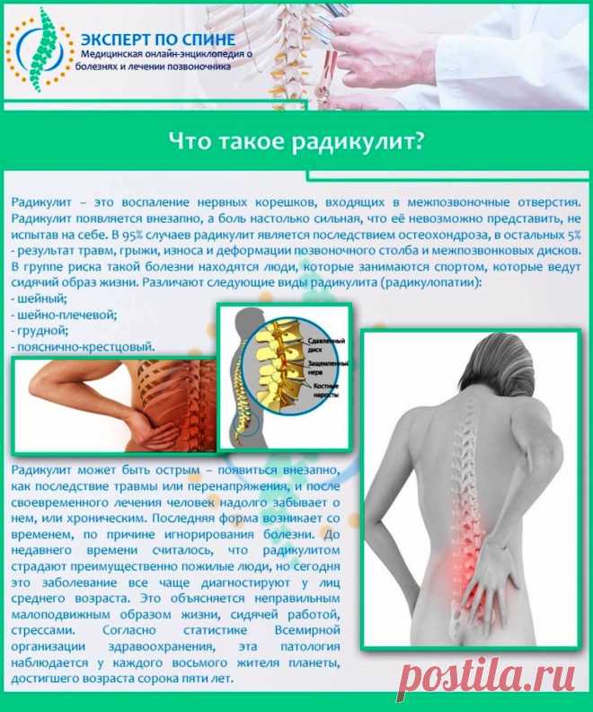 Что такое радикулит?