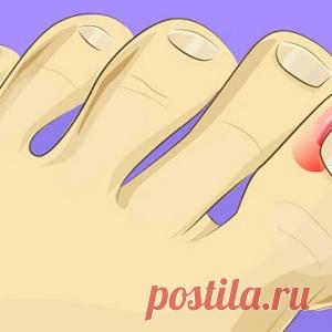 Врастание ногтей – серьезная проблема... Но от нее можно легко избавиться в домашних условиях!