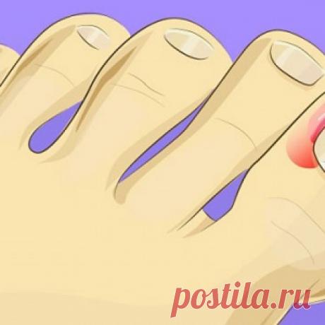 Врастание ногтей – серьезная проблема... Но от нее можно легко избавиться в домашних условиях!