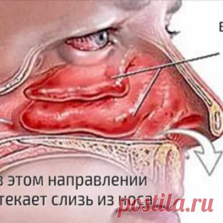 Заложенность и отек носа пройдут через несколько секунд, если просто нажать на эти точки! (ФОТО)